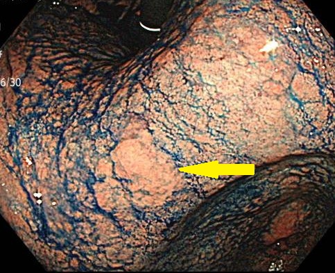 胃のポリープ、本当に放っておいて大丈夫？～消化器内視鏡学会内視鏡専門医が解説する「胃ポリープの種類・原因・治療法と注意すべきこと」～