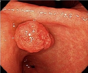 胃の隆起性病変について　どんな隆起が治療必要ですか？？