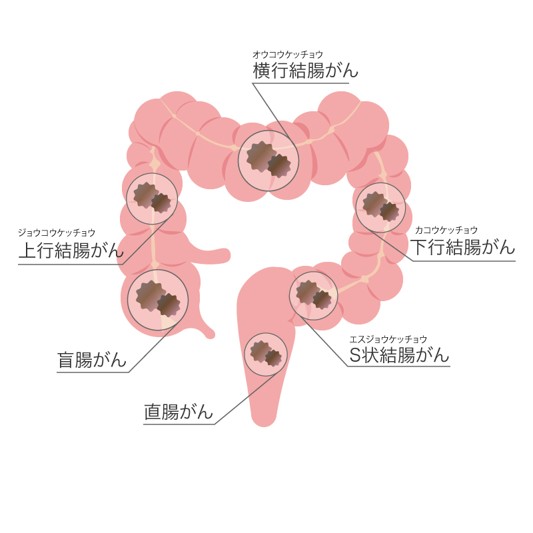 大腸がんの原因菌が判明？